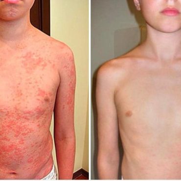 skutecznosc tlenoterapii